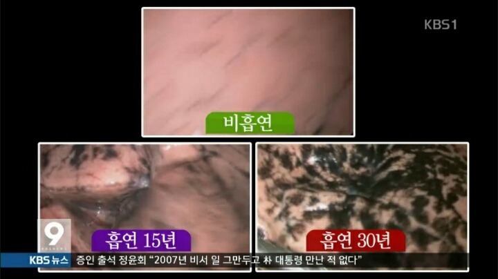 흡연자의 폐 | 인스티즈